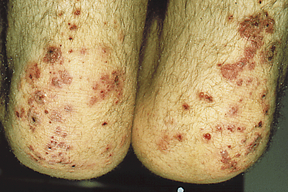 Dermatitis Herpetiformis 