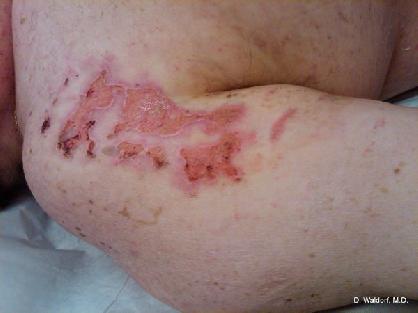 Linear IgA bullous dematoses from vancomycin by courtesy of Donald Waldorf, M.D.