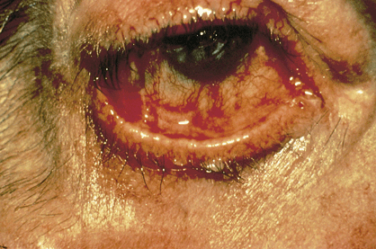 Cicatricial pemphigoid This is a chronic autoimmune subepithelial blistering disease 