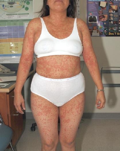 Severe rash associated with atazanavir Walkty, A. et al. “Severe Skin Rash Associated with Atazanavir." Canadian Journal of Infectious Diseases and Medical Microbiology 20(1): e10-e12. PMC. Web. Spring 2009.  2009.