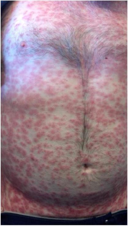 Painless, non-pruritic edematous papules from ibrutinib Mannis, G. et al. "Ibrutinib rash in a patient with 17p del chronic lymphocytic leukemia." American Journal of Hematology (2015) 90(2): 179. PMC. Web. 25 Aug 2015. 